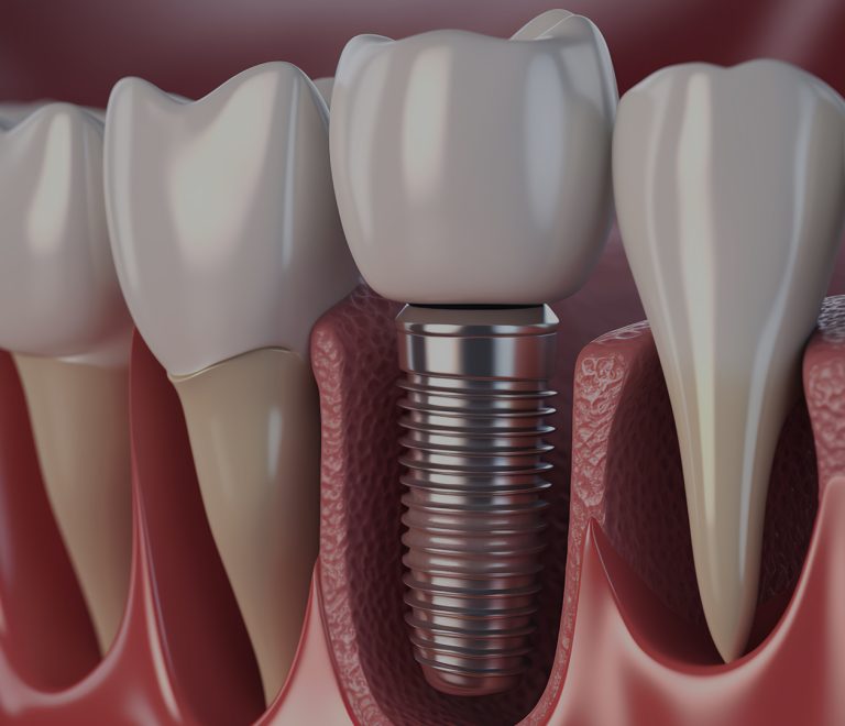 Diş İmplantları: Eksik Dişlere Kalıcı Çözümler